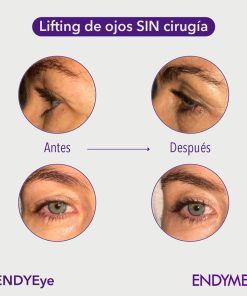 Flacidéz de párpados y ojeras 1 sesión
