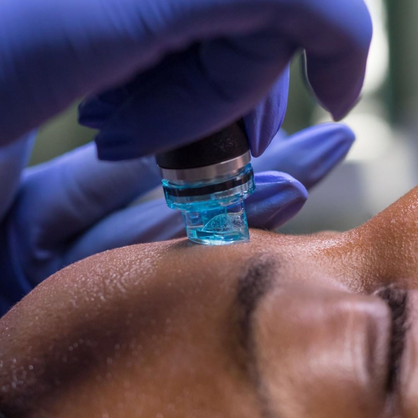 Hydrafacial Deluxe