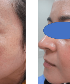 Tratamiento Láser Melasma 5 sesiones