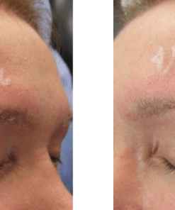 Despigmentante para Microblading