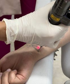 Láser SPECTRA borrado de tatuajes (Mediano)