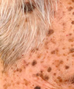 Queratosis Seborreica