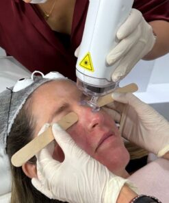 Láser Co2  Rostro Completo